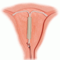 Méhen belüli fogamzásgátló eszközök (IUD) Termékajánló