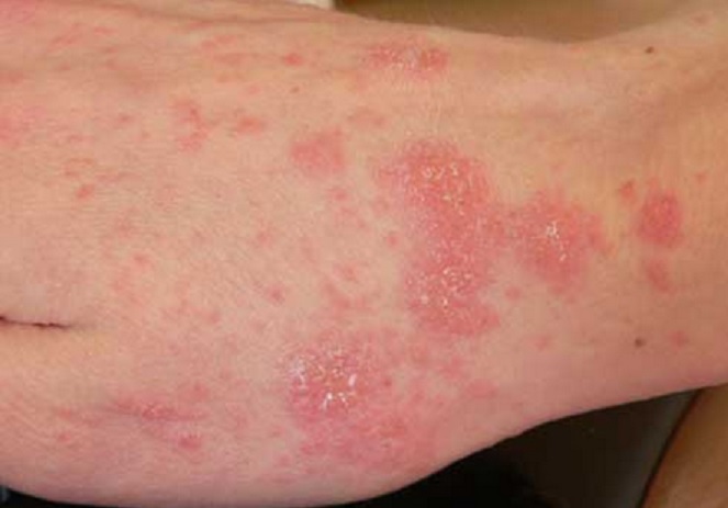 bőrbetegség parazita